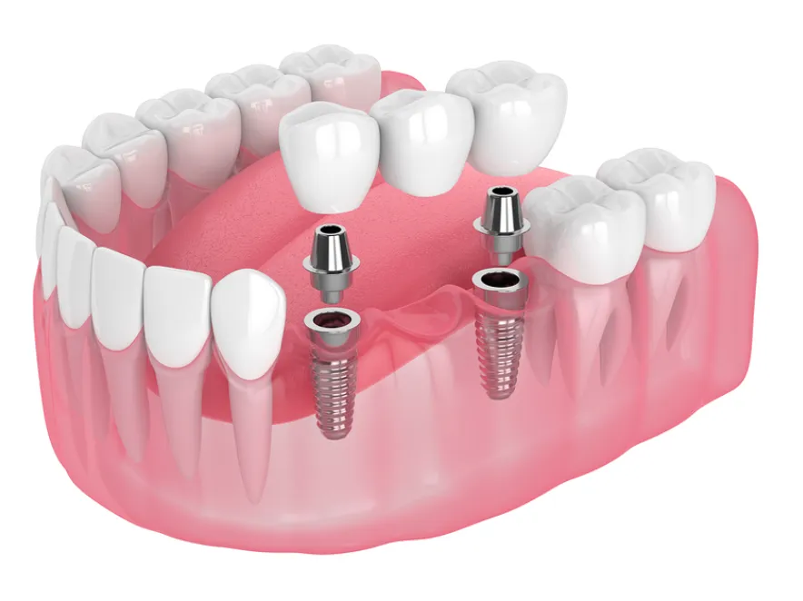 How Emergency Dental Care Can Bridge Healthcare Gaps